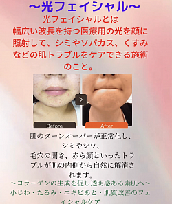 光フェイシャル料金